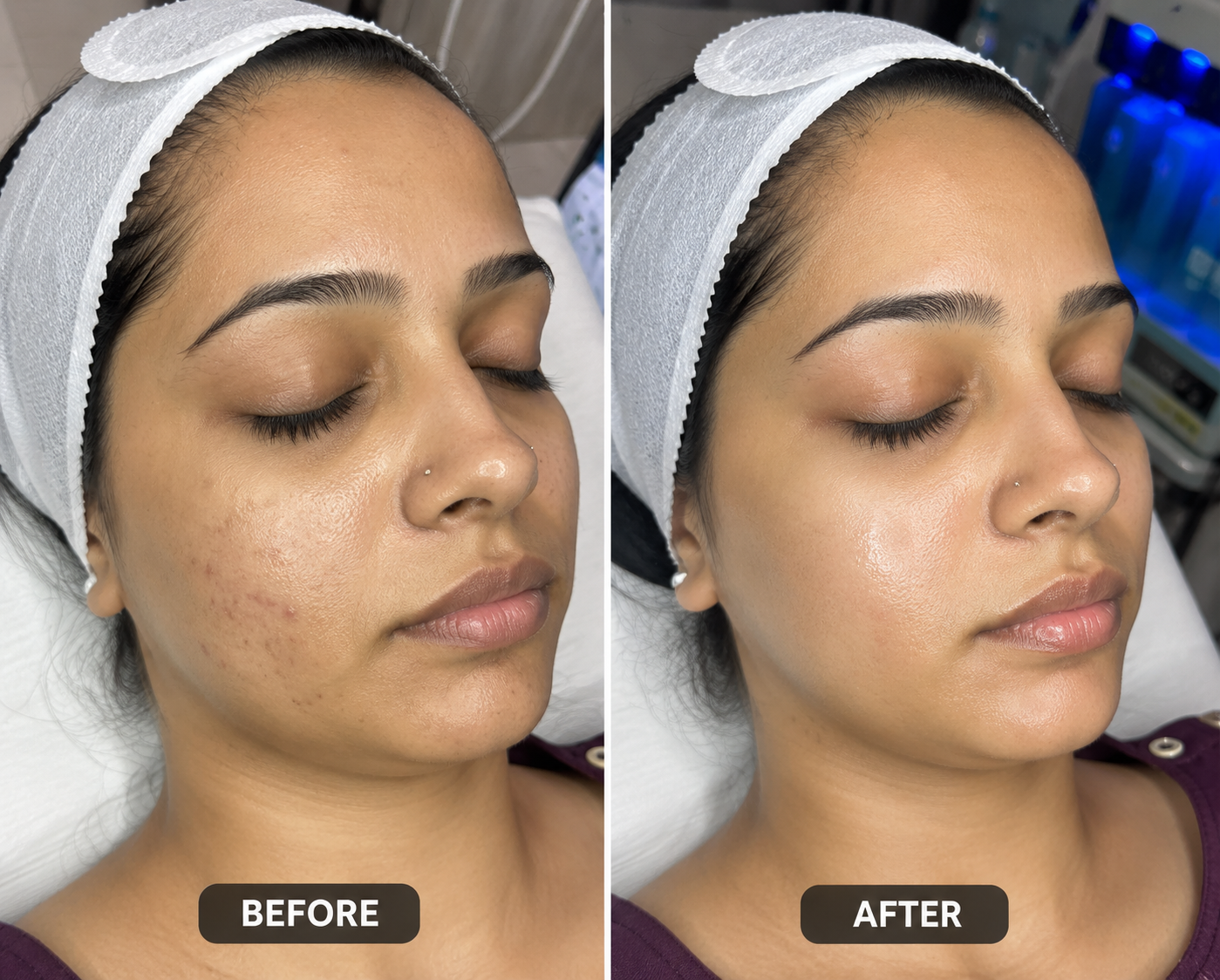 Hydra Facial Glow